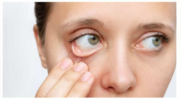 Pale conjunctiva indicating potential anemia