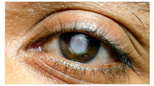 Illustration depicting the effect of glaucoma on vision