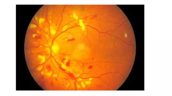 Fundoscopic image showing hypertensive retinopathy