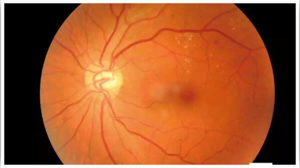Illustration of diabetic retinopathy