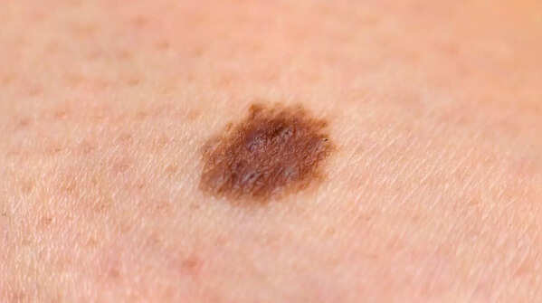 Color change: Pigment spreading beyond a mole