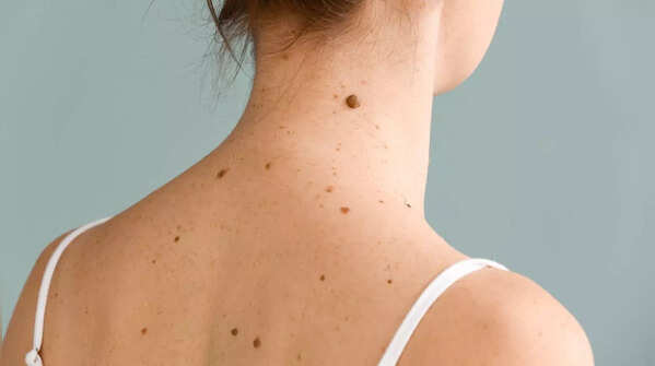 New mole: A possible sign of concern