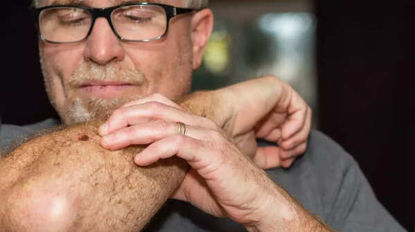 Understanding the ABCDE rule for mole examination