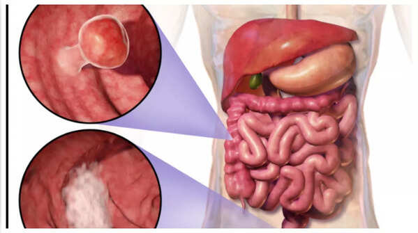 Depiction of blood in stool, a possible sign of colon cancer
