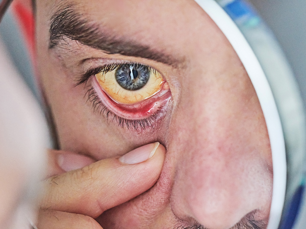 Jaundice, characterized by yellow eyes and skin, indicates liver dysfunction.