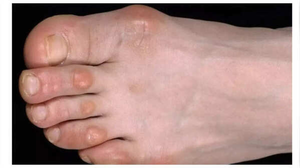 Painful lumps on fingers can be a sign of a heart condition