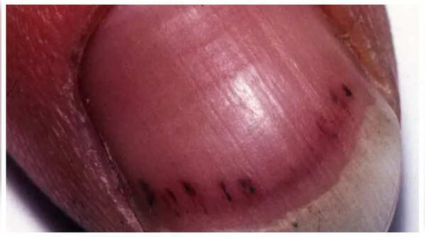 Red lines under nails signaling heart problems