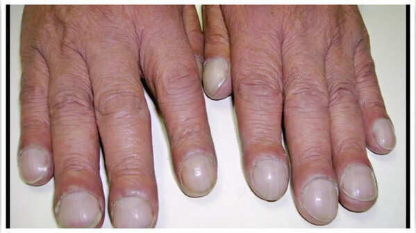 Curved nail shape indicating possible heart condition