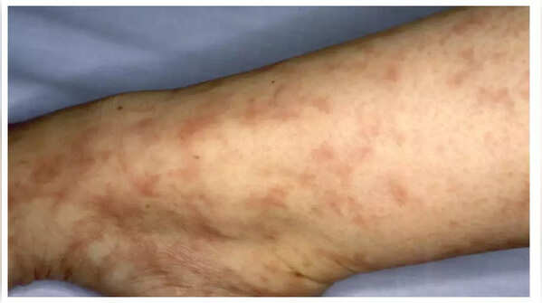 Lacy pattern on skin indicating cholesterol issue