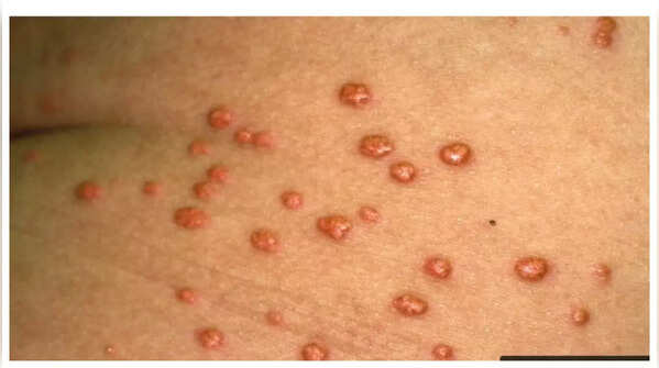 Yellowish bumps on eyelids as a sign of high cholesterol
