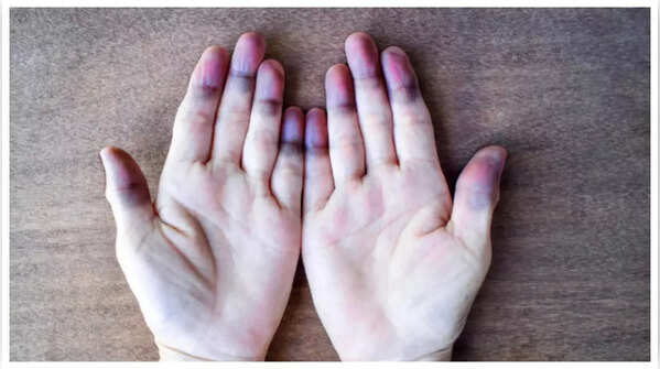 Blue discoloration of skin on toes