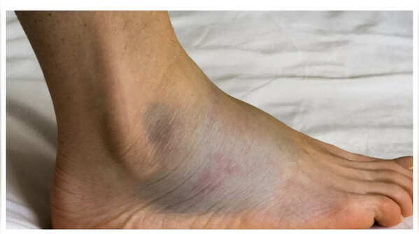 Swollen ankles and feet indicating potential heart issues