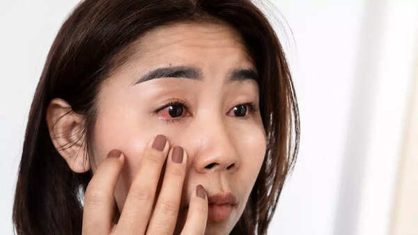 Using rose water to soothe eyes